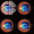 Integration of Structure and Function Provides a More Accurate Interpretation of VF Results